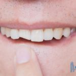 how-to-treat-a-chipped-tooth