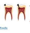 can-tooth-decay-be-reversed
