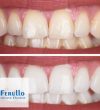Effective tips for teeth whitening from your trusted dentist